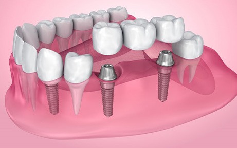 Dental implants with crown and bridge