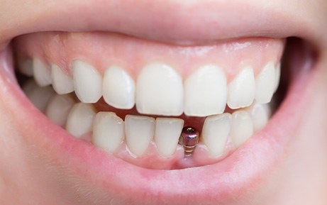 Dental implants save you money because they won’t need to be replaced frequently like dentures and dental bridges will.
