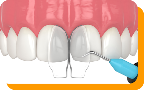 Illustration of bonding material being applied to a chipped front tooth