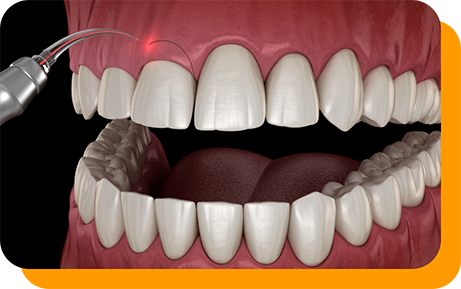 Illustration of a dental laser treating an uneven gumline