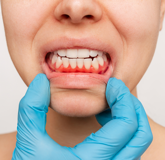 Person pointing to their red gums before gum disease treatment in Clearwater