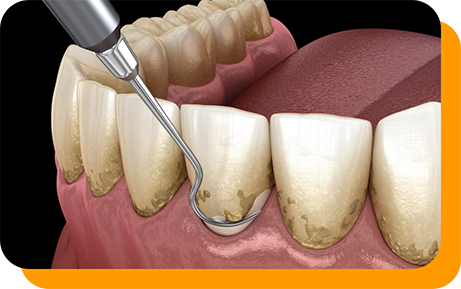 Illustrated dental scaler clearing plaque buildup from the gumline