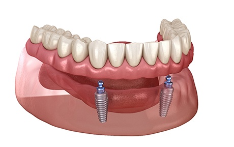 Image of ball-retained dentures with white background