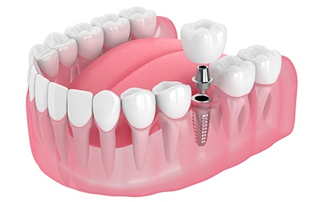 Illustration of single dental implant