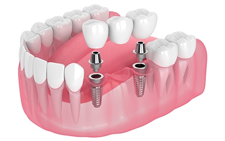 Illustration of implant bridge