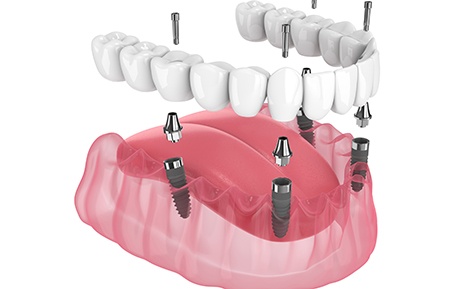 Illustration of implant denture