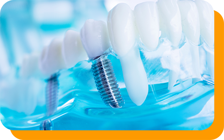 Model of two dental implants supporting a dental bridge