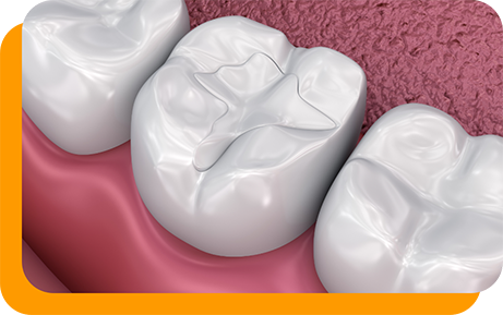 Illustrated tooth with a white filling