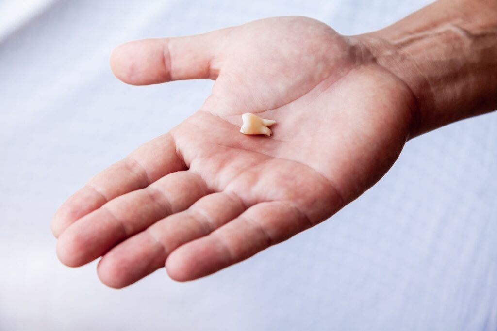Man with large dislodged tooth in palm of hand