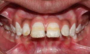 Close-up of stained teeth. 